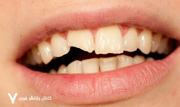 چرا دندان‌ها زود به زود پوسیده می‌شوند؟