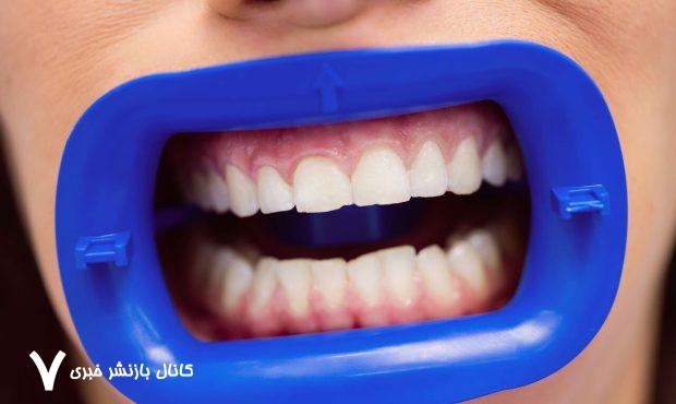 آیا خدمات دندانپزشکی در ایران لوکس محسوب می‌شود؟
