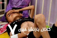 تراژدی ۶۰۰ روز جنگ در غزه؛کودکانی که به اسکلت تبدیل شده‌اند