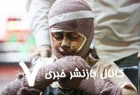 با سوختگی ناشی از حملات جنگی چه کنیم؟