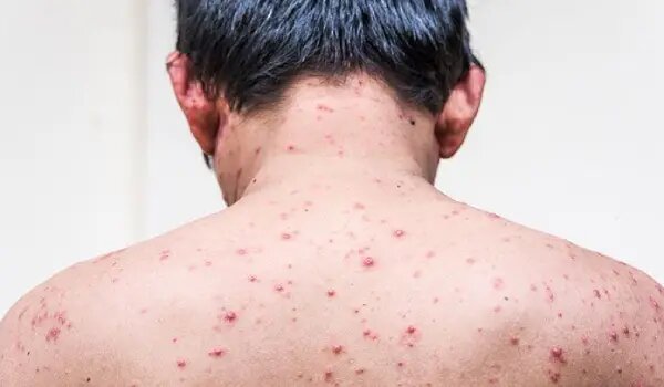علائم آبله‌مرغان در بزرگسالان خبرآنلاین